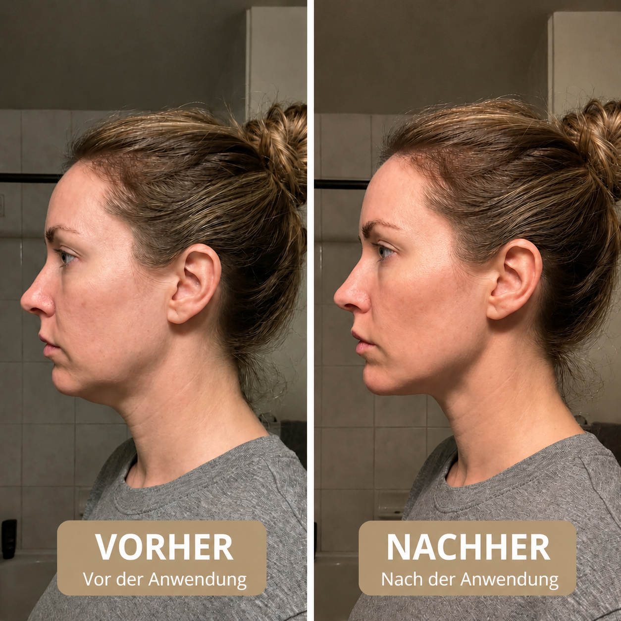 Vorher und nachher — Kieferdefinition in 4 Wochen